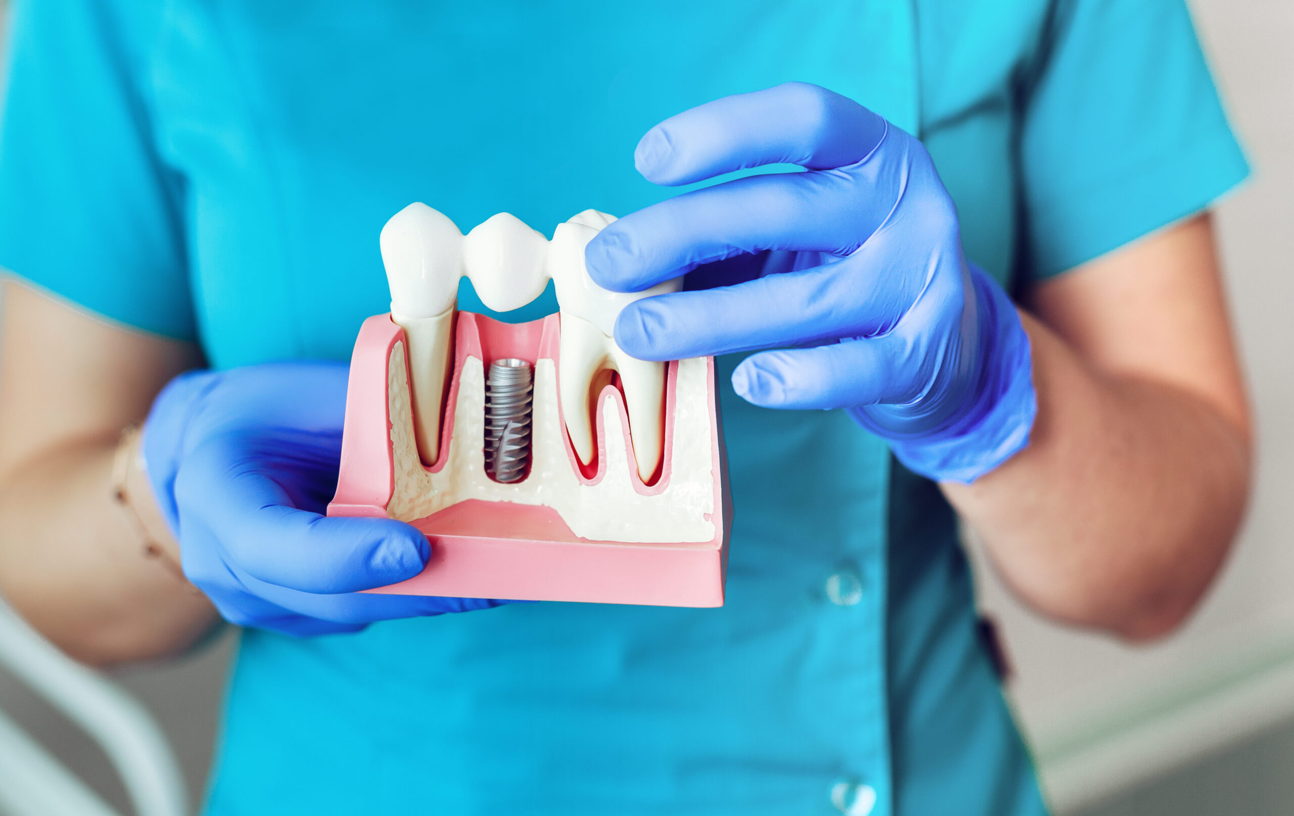 Зубні імпланти – які ціни?