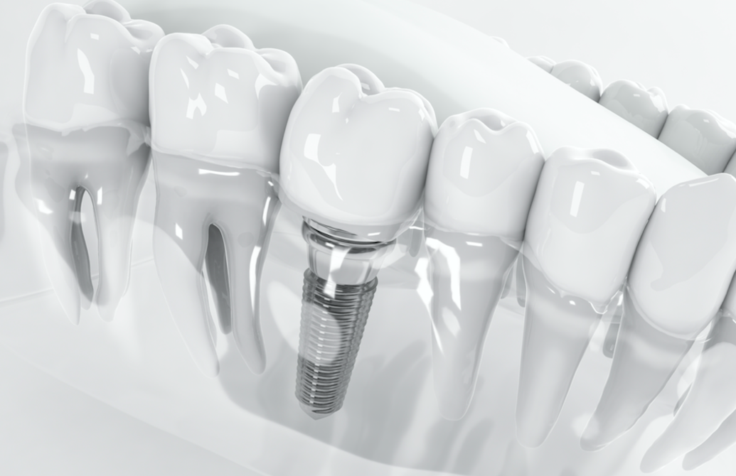 Імплантація зубів: переваги у відновленні втрачених зубів