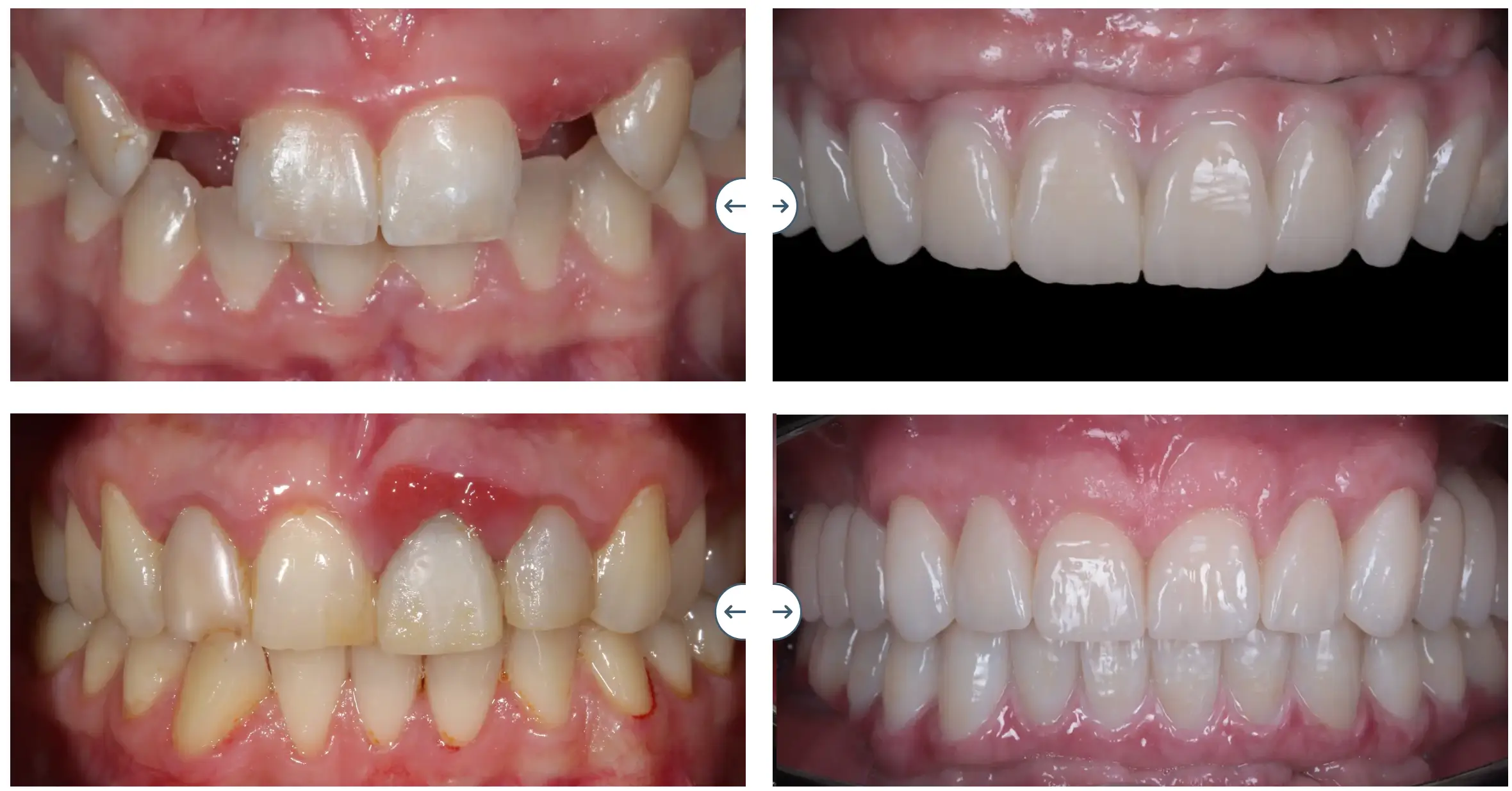 до та після - Стоматологія PICASSO Вул. Бабʼяка (Бобяка), 1Б, ЖК «Crystal» +38 097 247 57 47
