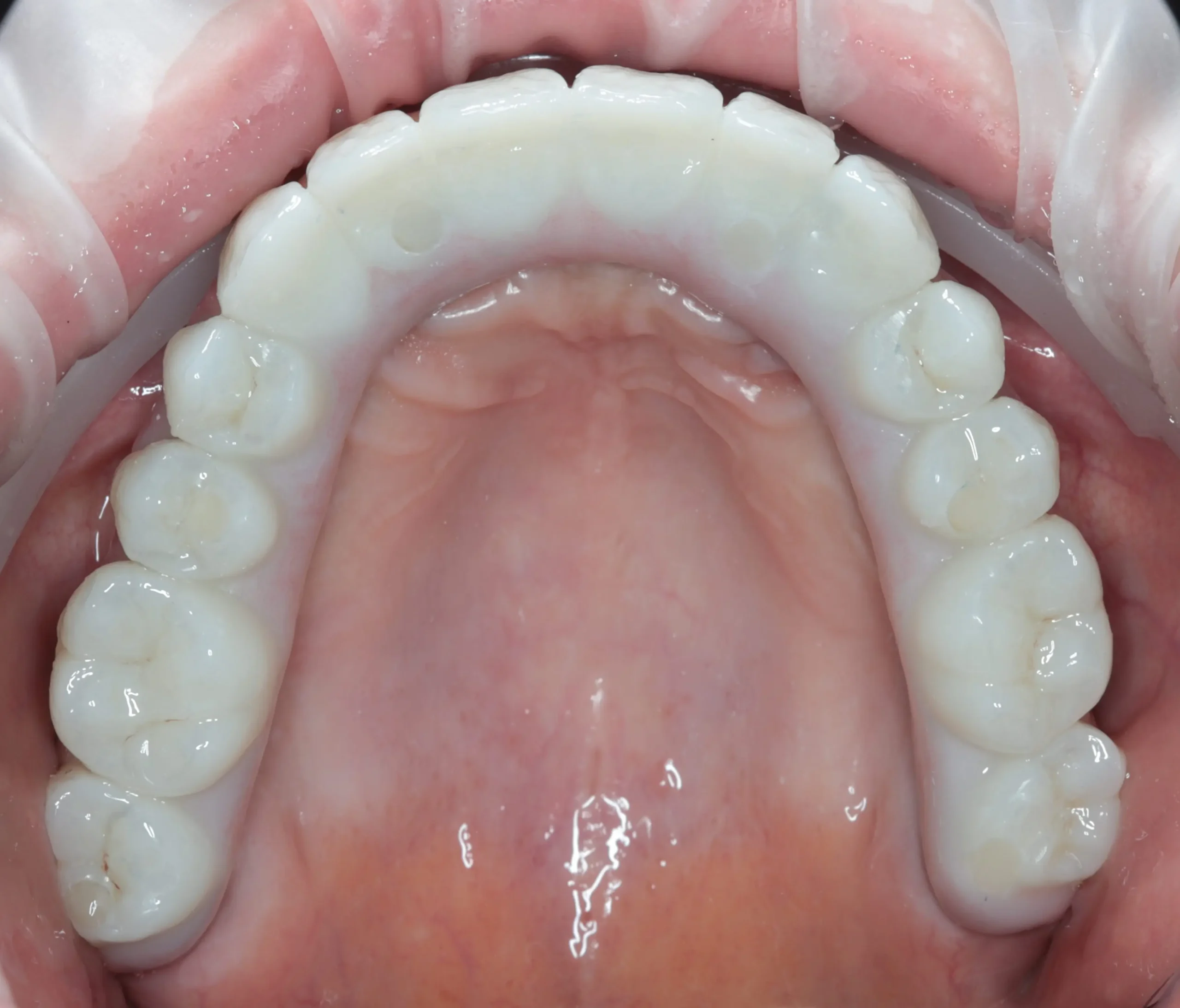 Цирконієві коронки: відгуки пацієнтів, реальні плюси і мінуси — що варто знати перед протезуванням